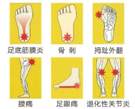 一分钟认识扁平足,扁平足的日常表现和危害有哪些