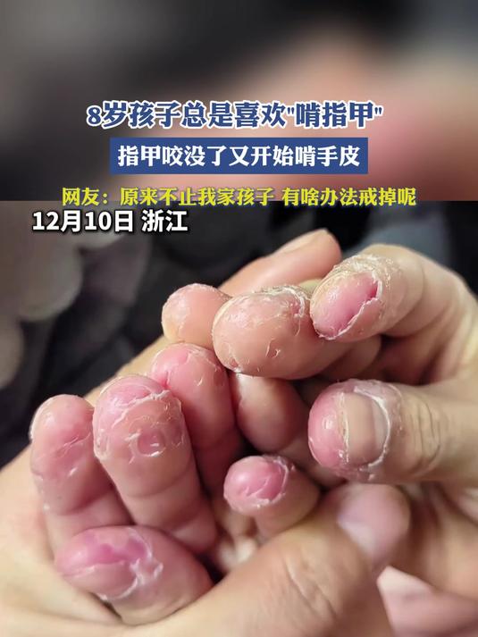 8岁孩子总是喜欢啃指甲,指甲咬没了又开始啃手皮