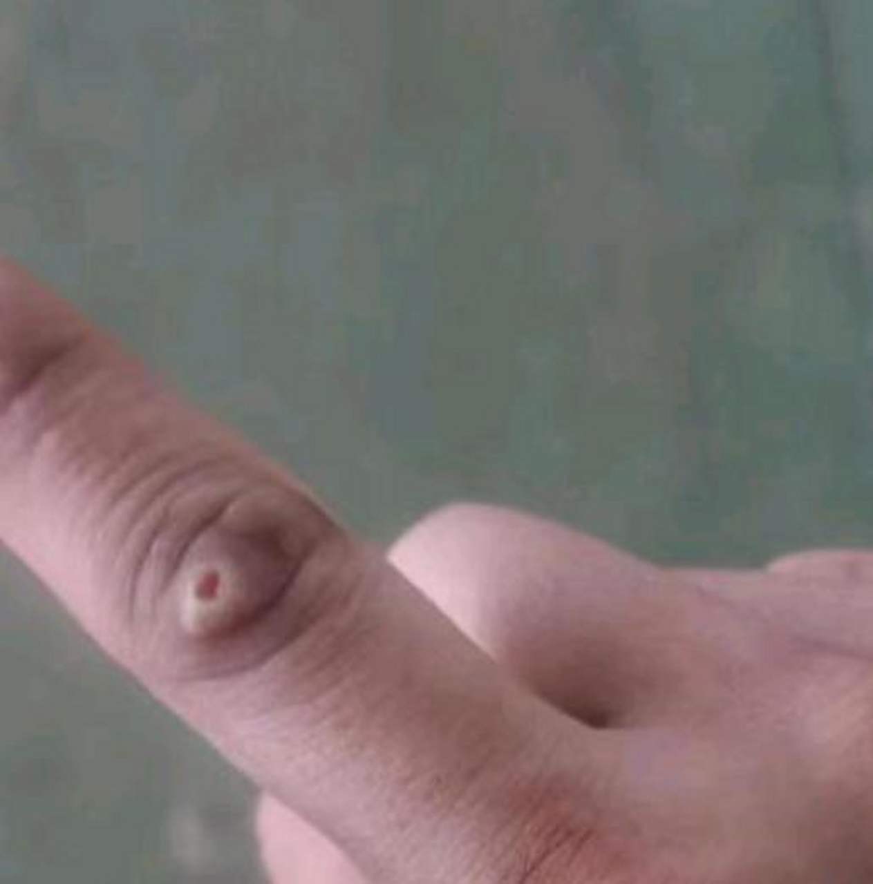 脚上的叫鸡眼,那手上的叫啥?