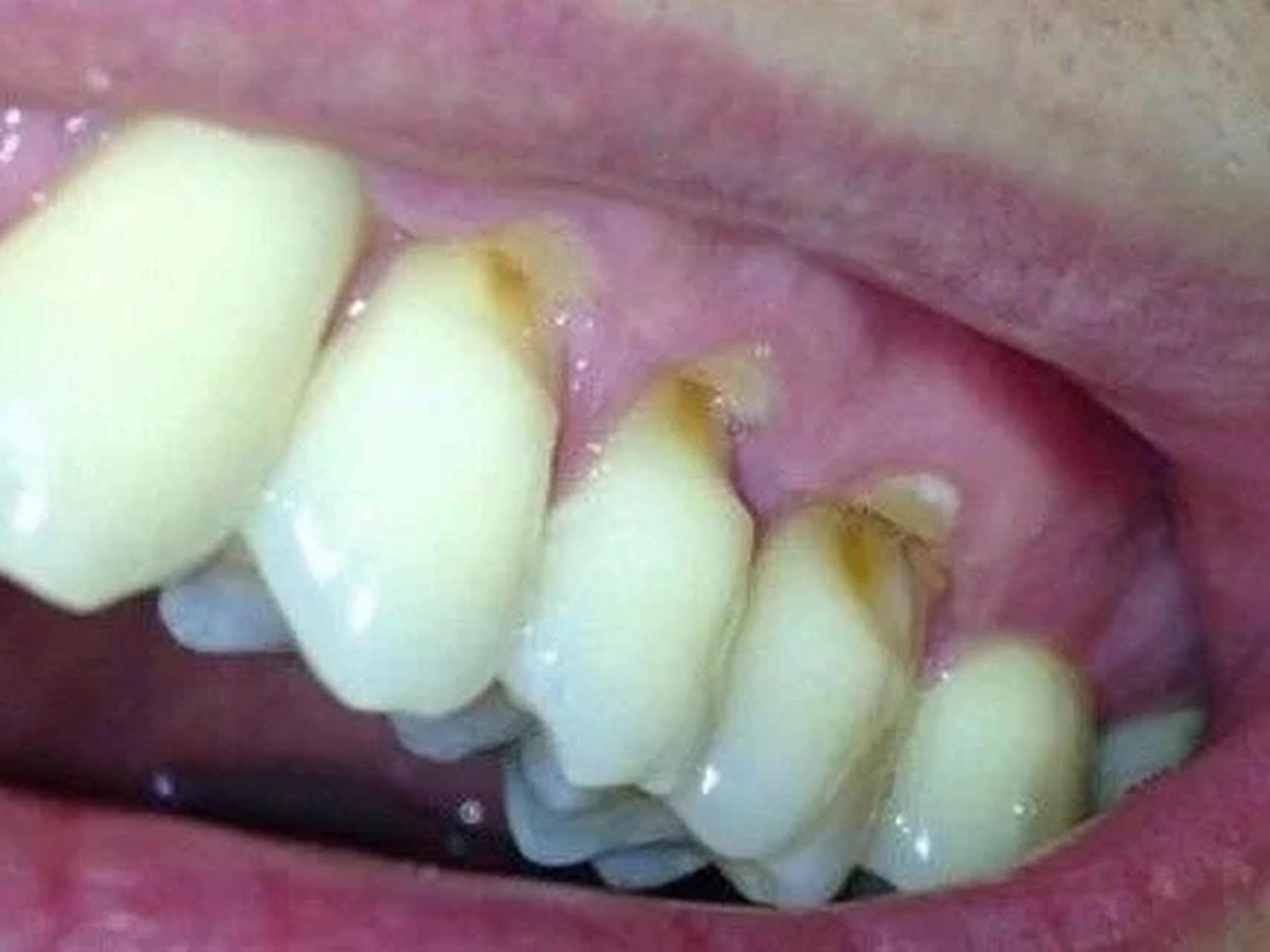 牙齿楔状缺损,到底是怎么形成的?