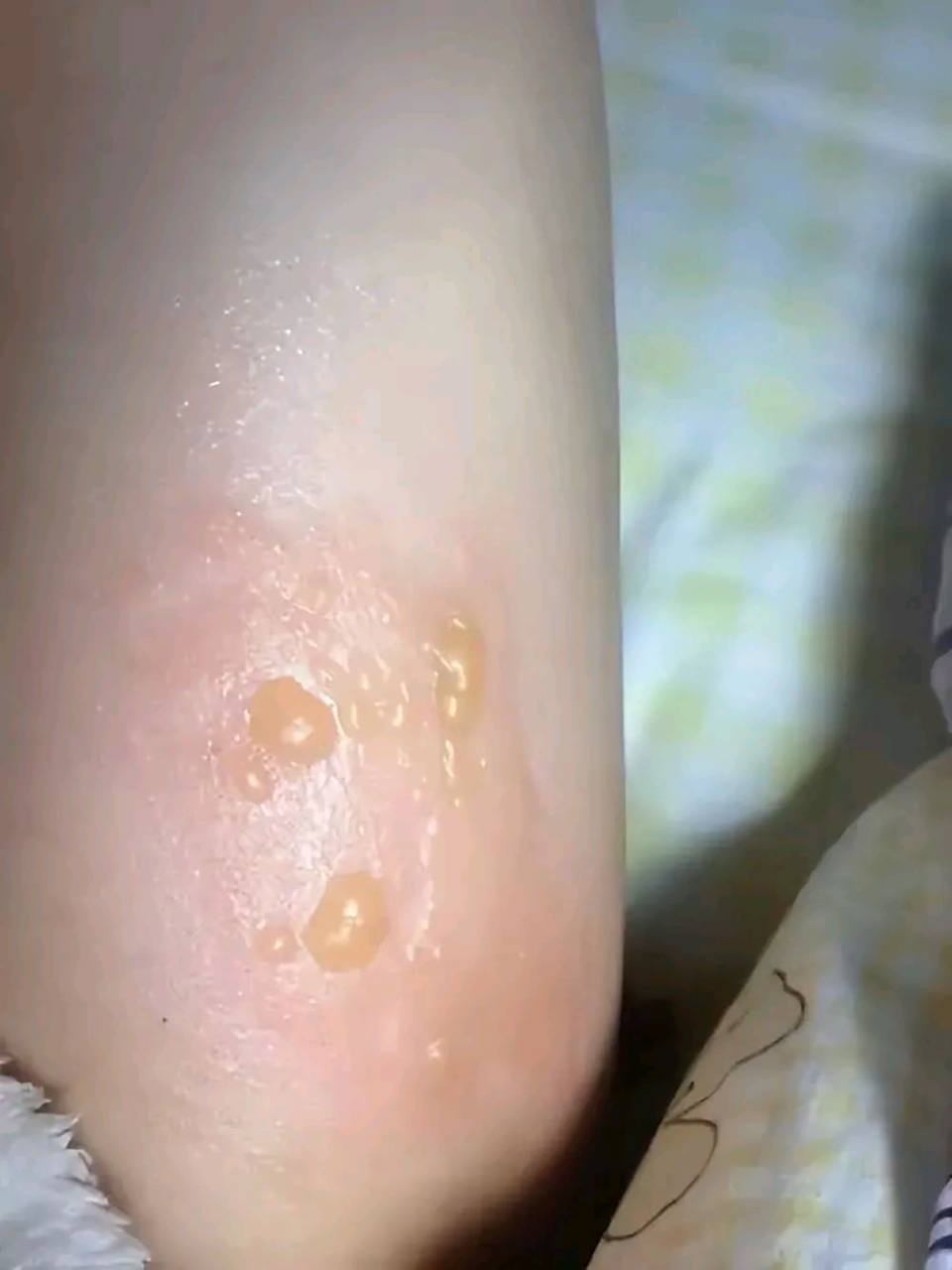 女子下体被马桶喷出开水烫伤,二度伤.大家都听说过智能马桶吧!