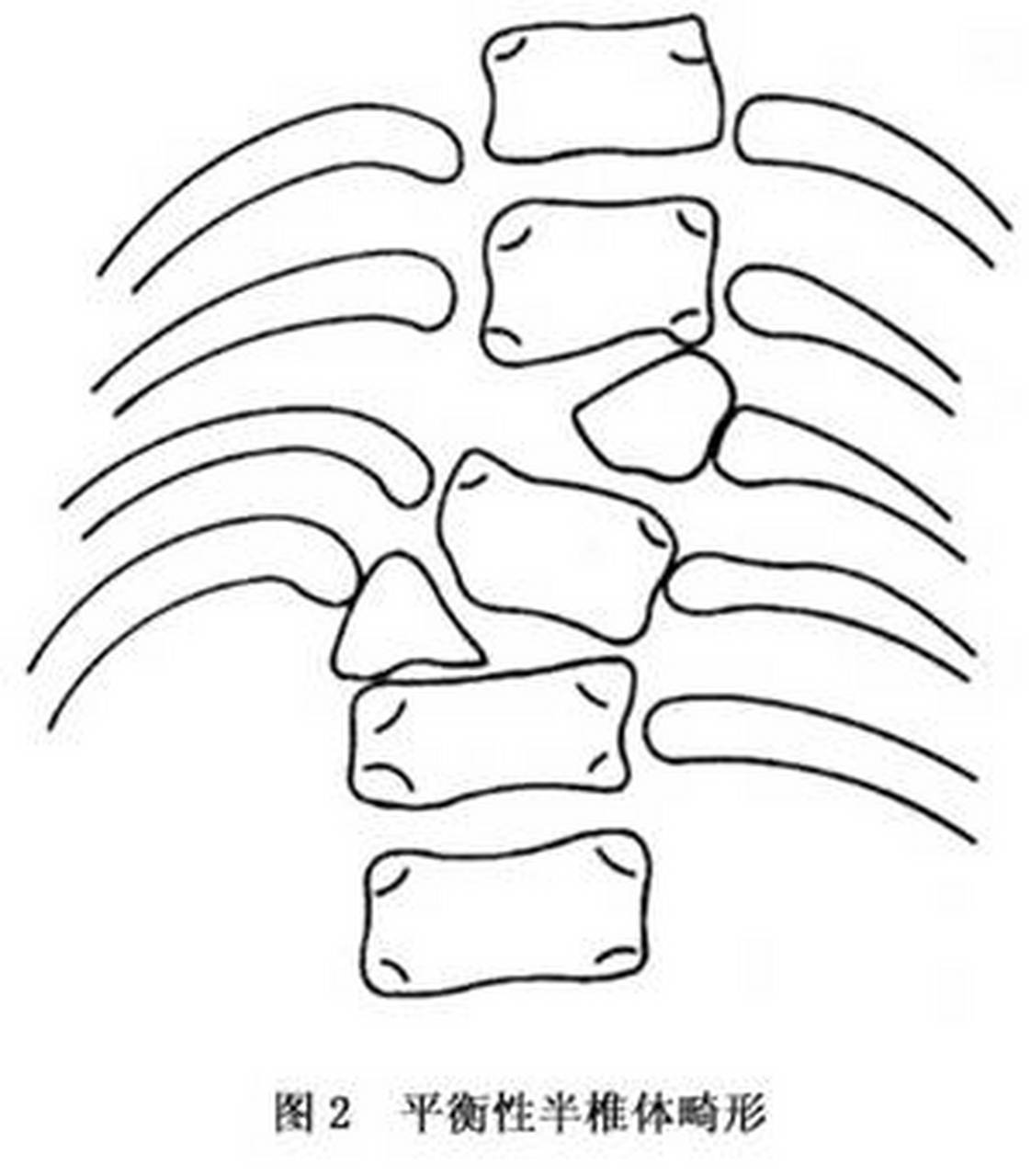 半脊柱扭转图片