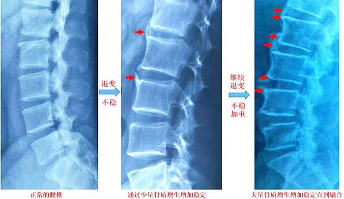 骨质增生和腰椎间盘突出是一回事吗?