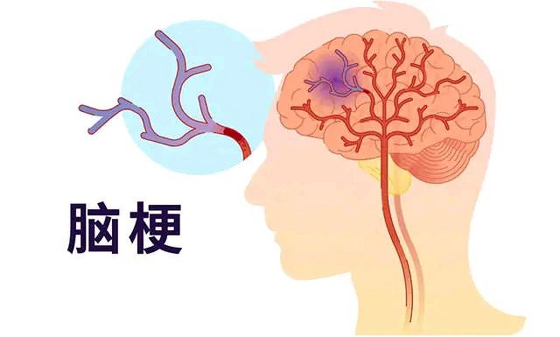 脑梗走路诀窍图片