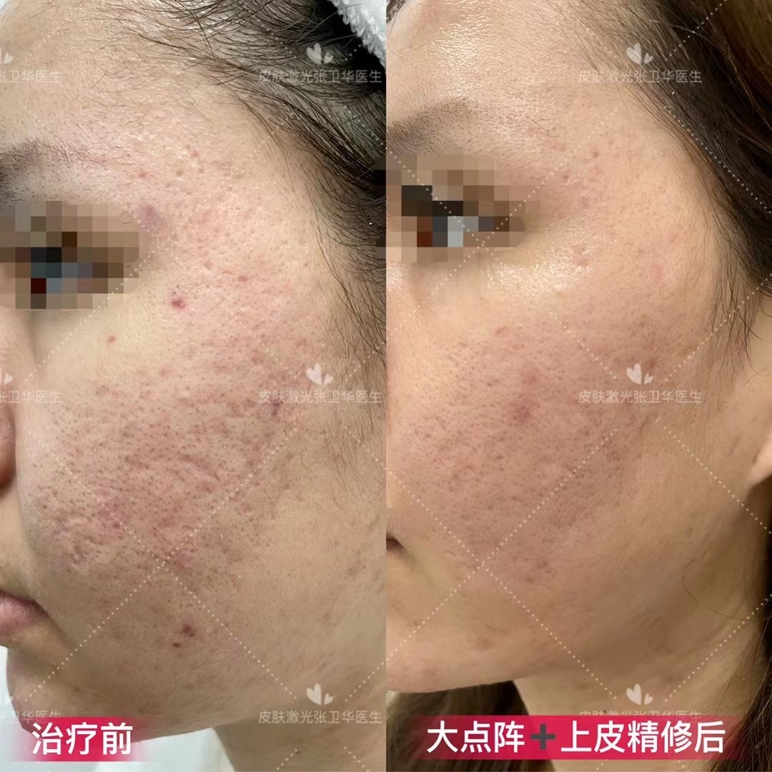 严重车厢型加深锥型痘坑半组治疗后效果明显