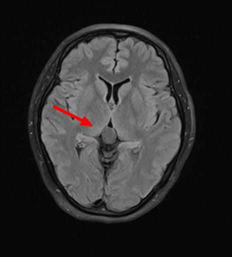 松果体囊肿是个啥,严重吗?