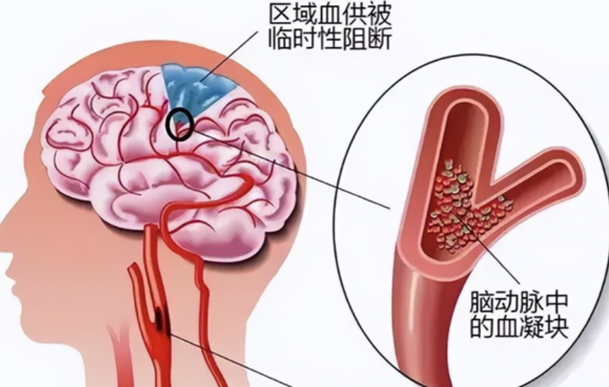 脑梗示意图图片图片