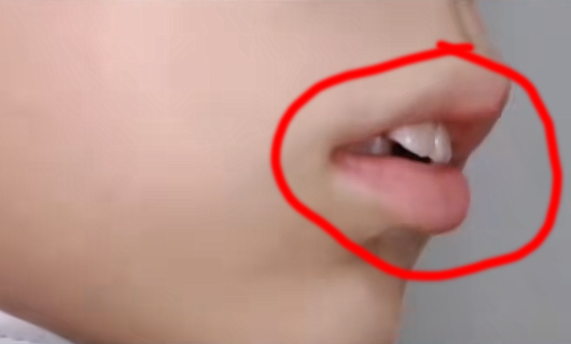 孩子腺样体肥大等到自然萎缩,面容就已经毁了!