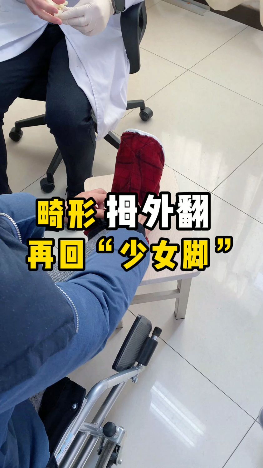 重度拇外翻叠趾锤状趾术后也能走路