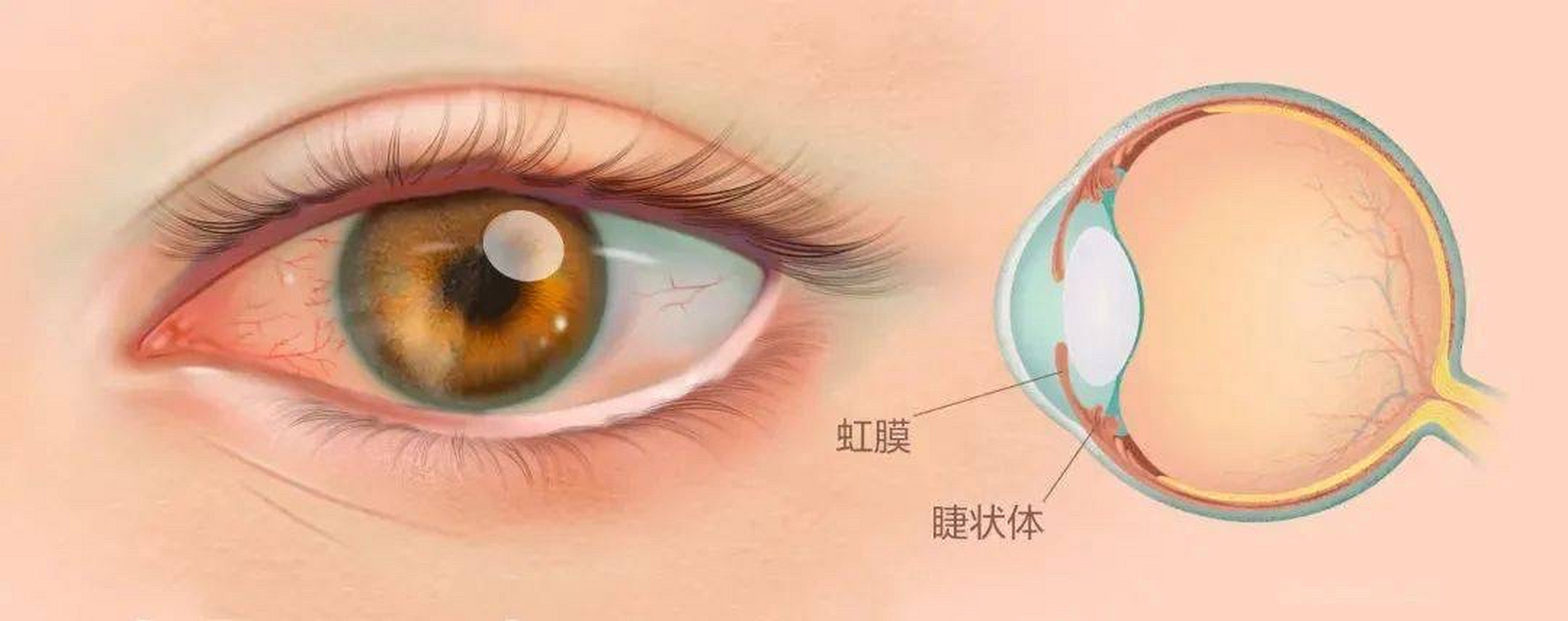 虹睫炎的患者应该如何保持眼睛的健康?
