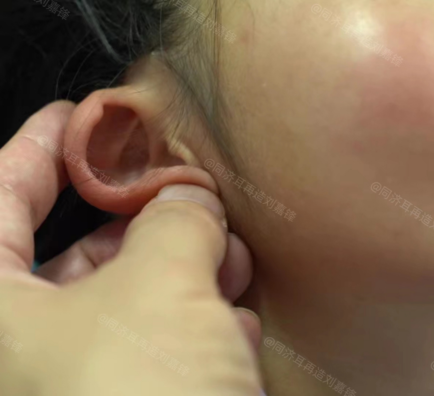 小女孩是湖北黄冈人,刚满五岁,两只耳朵缺少对耳轮,都立不起来.