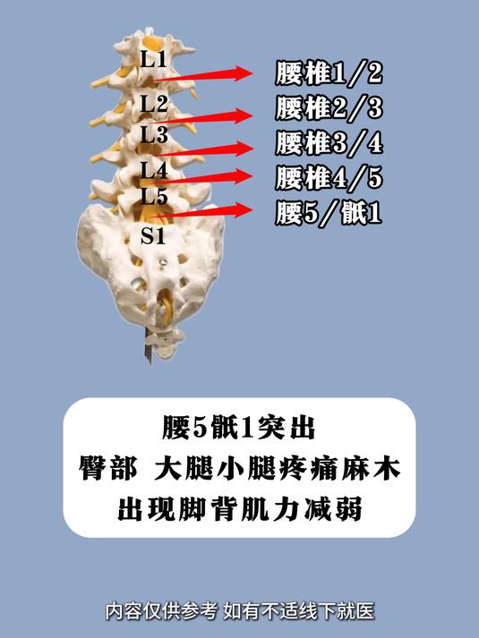 腰1椎在哪个位置图片图片