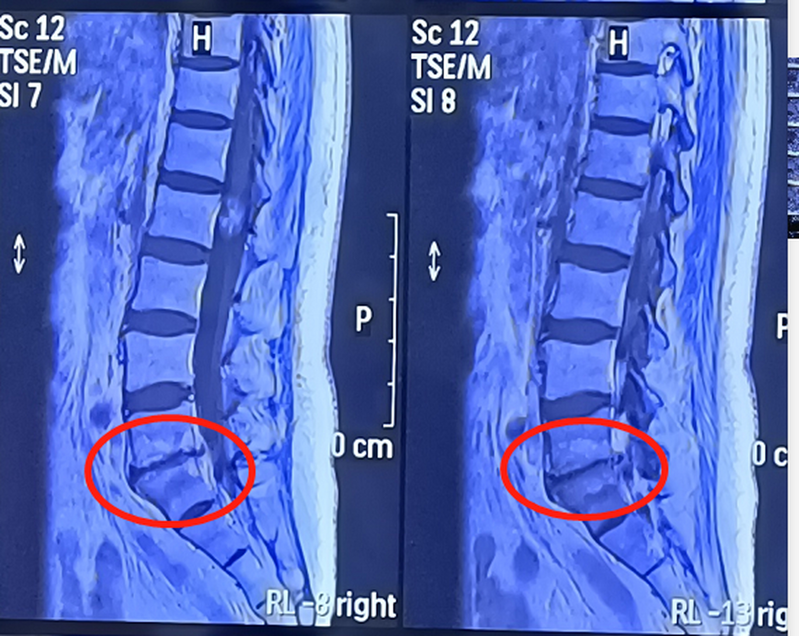 终板炎的主要症状是腰骶部的疼痛,它的疼痛特点是内部深在的钝痛,当