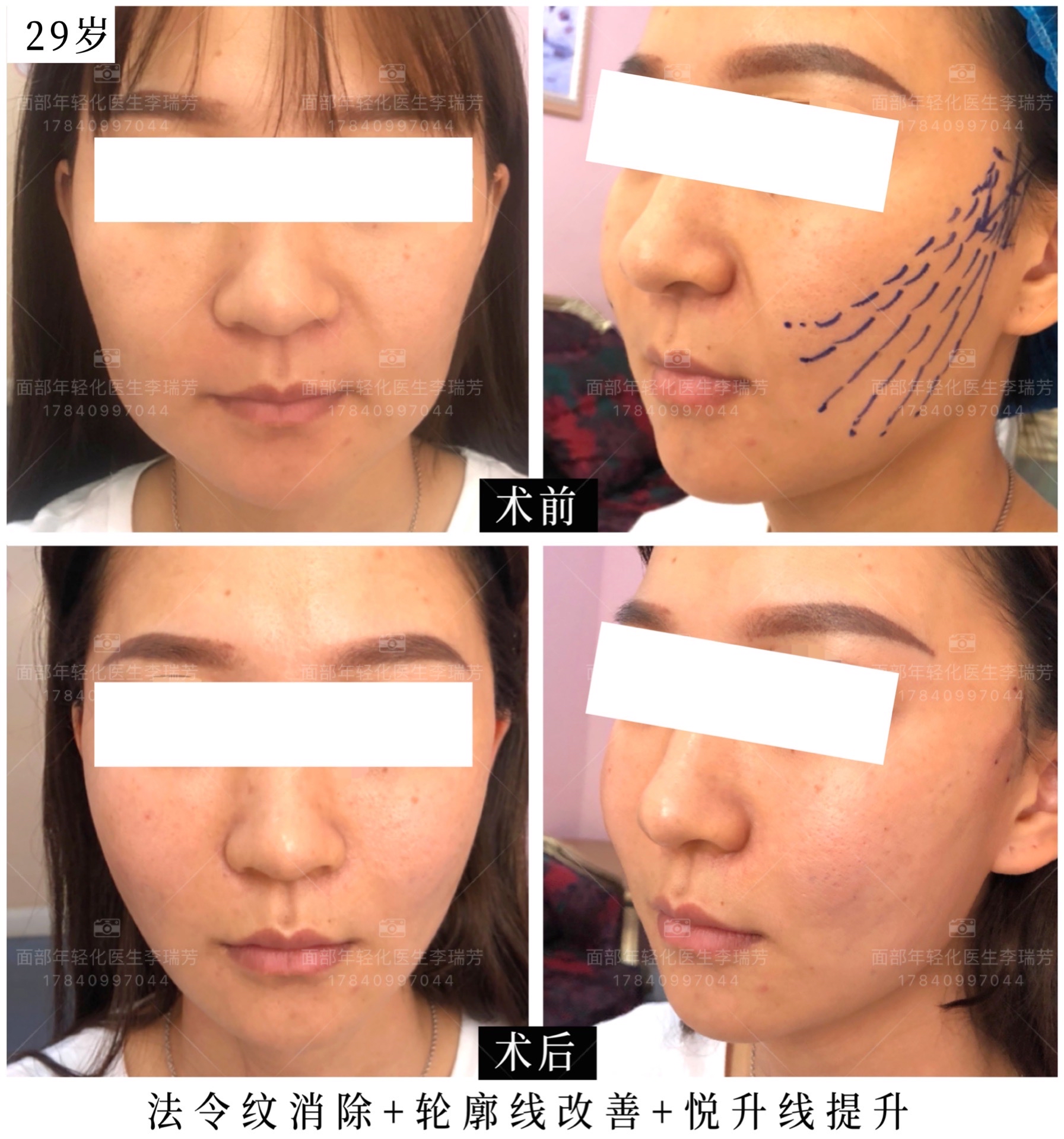 悦升线半个月:面对衰老如何改变?