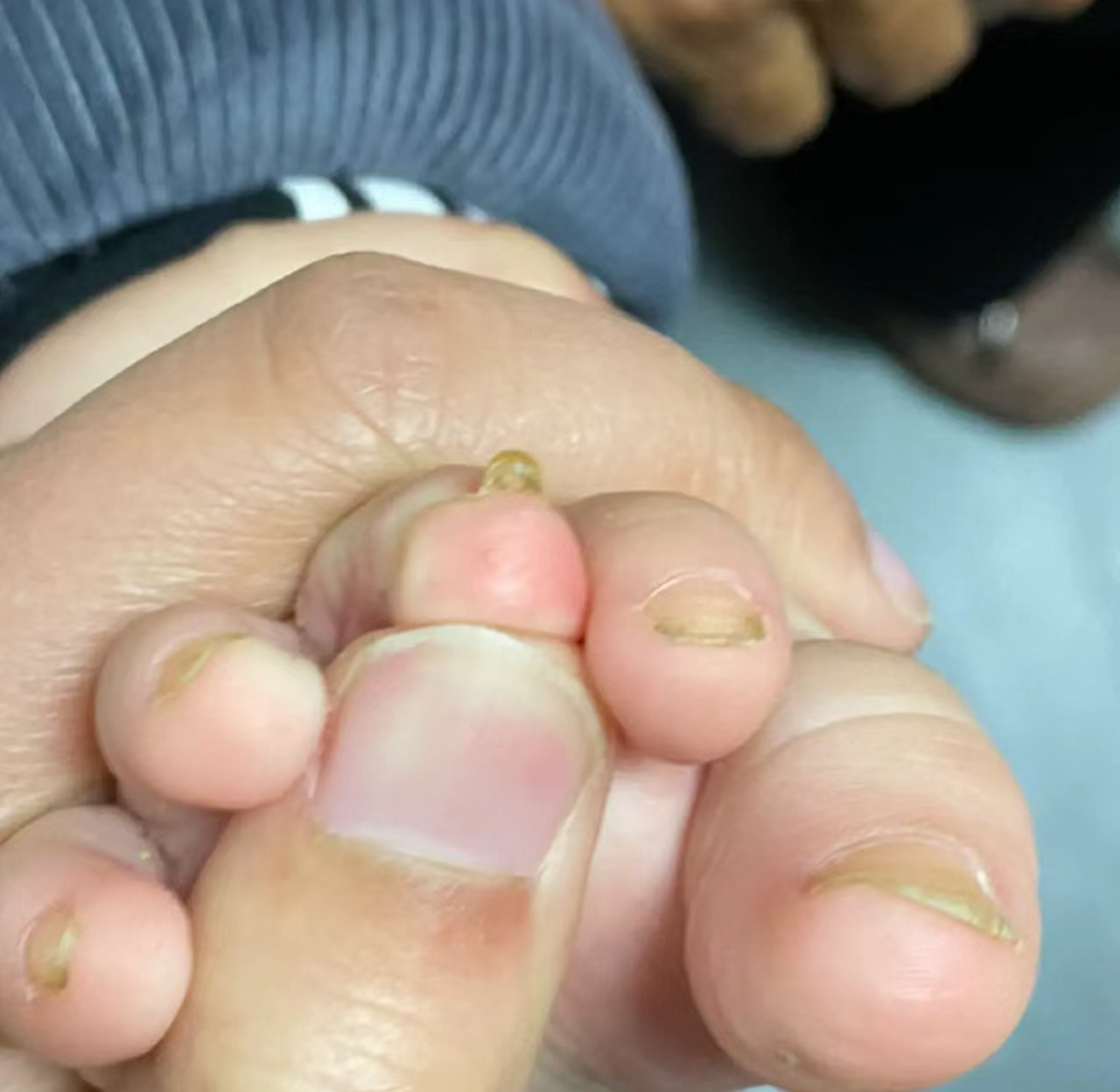 都是和他奶奶一起睡的今天我给他剪指甲就发现中间那个脚趾 很厚很厚