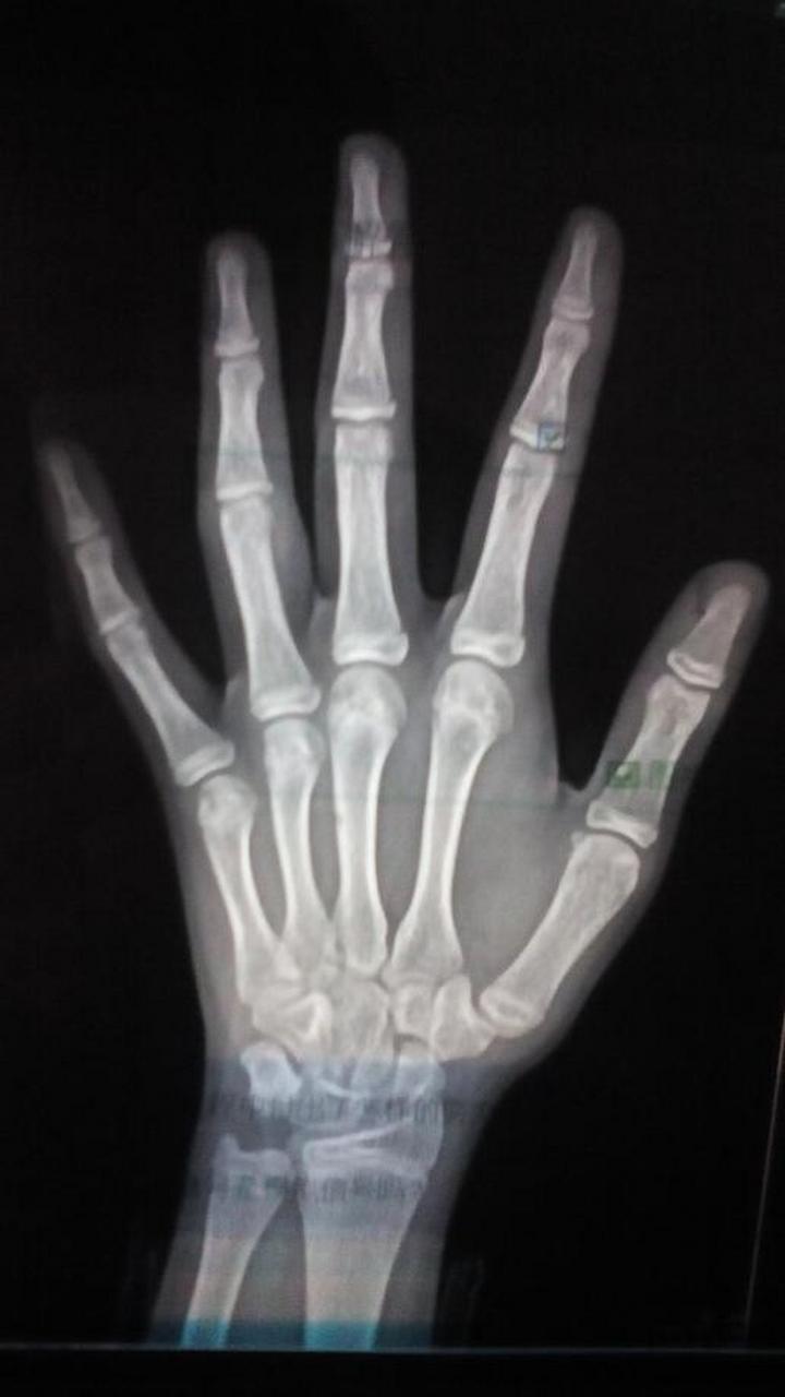 13岁男孩的骨龄片子