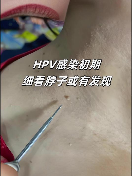 脖子感染hpv图片图片