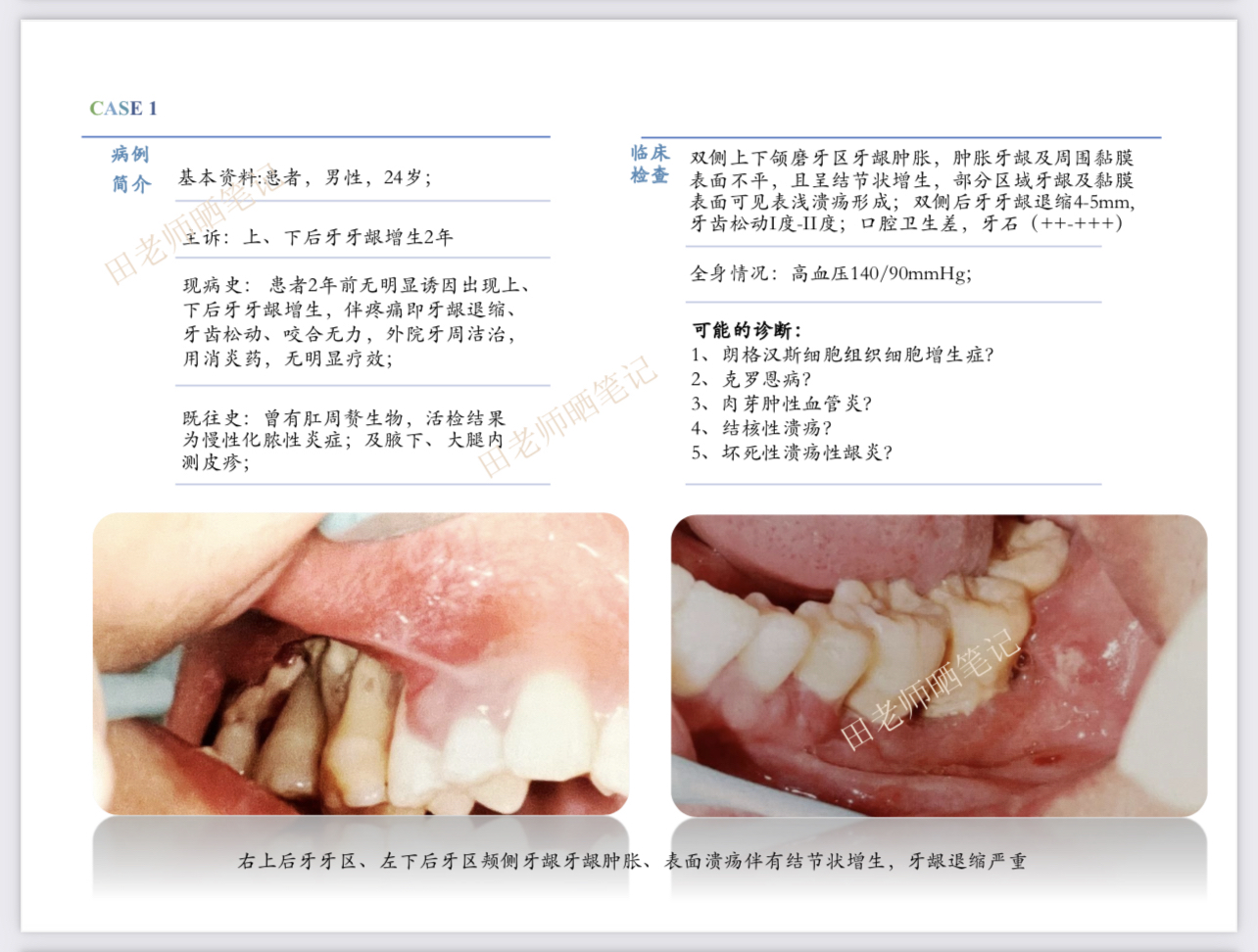 朗格汉斯细胞作用图片