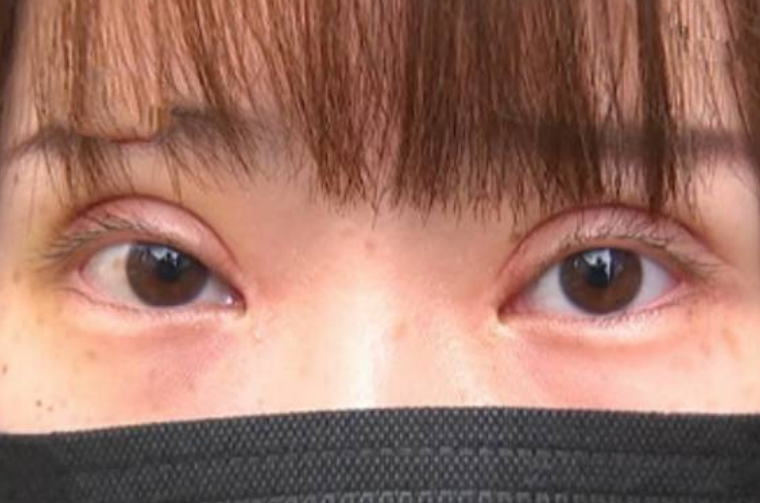 双眼皮术后睫毛外翻,是怎么回事?听听医生怎么说!