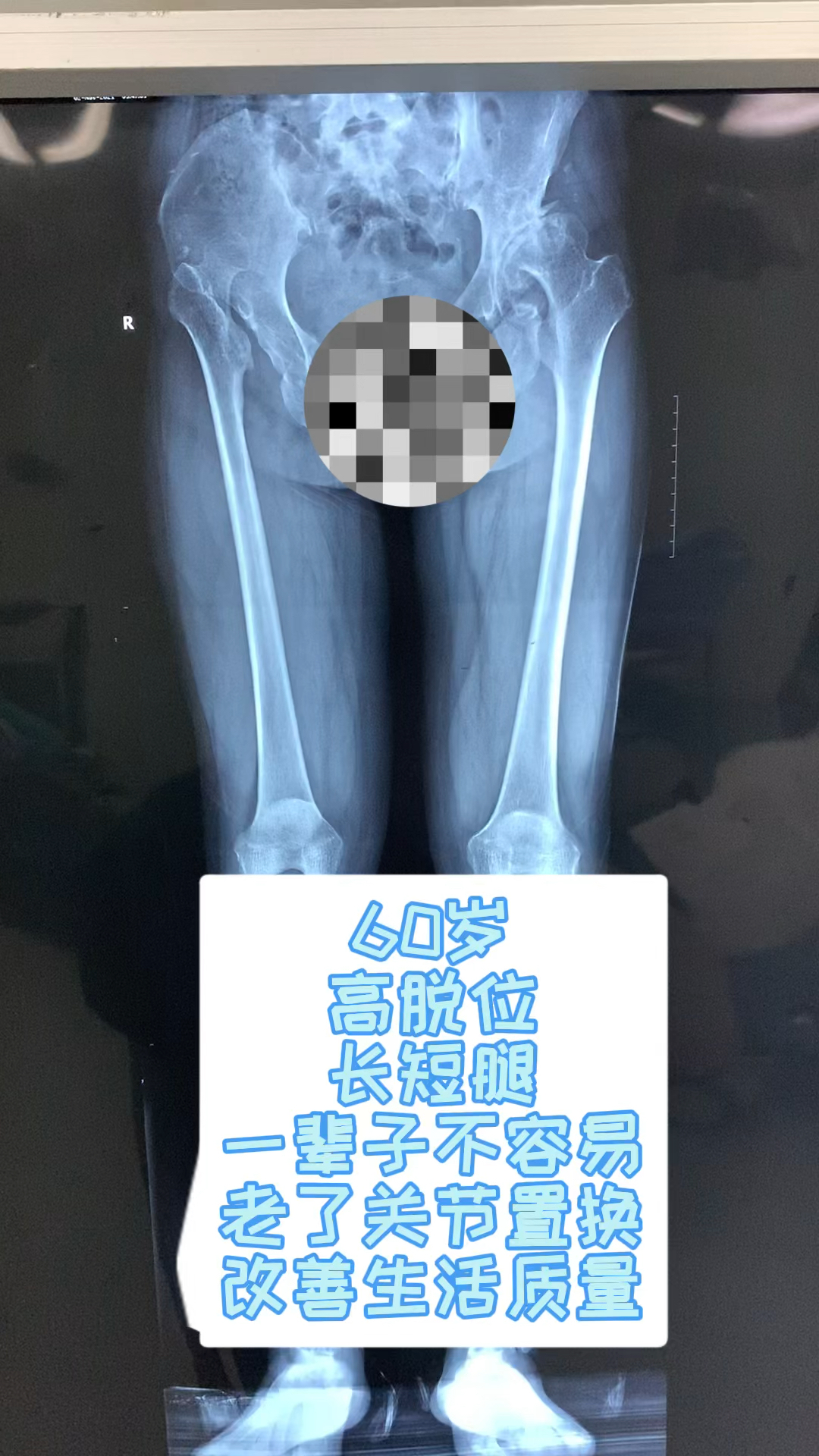 60岁高脱位髋关节发育不良,长短腿,一辈子太不容易,选择关节置换,改善