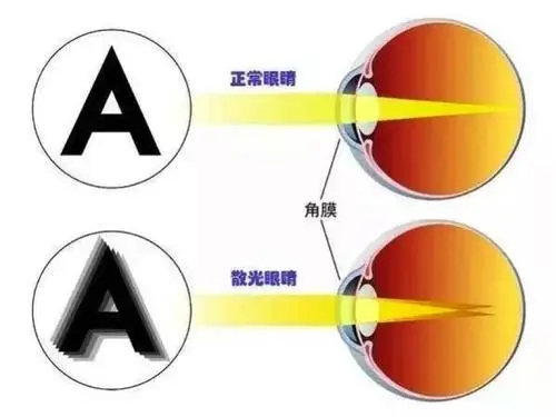 散光100度严重吗图片