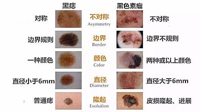 免疫治疗让晚期恶性黑色素瘤病人重获新生