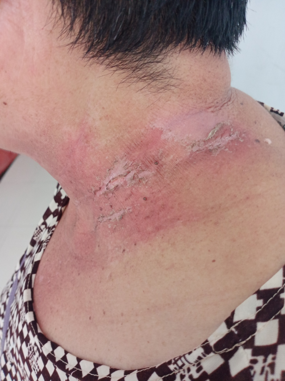 放疗副作用 一个疗程28次放疗,现在做到20次,副作用已经开始显现了.