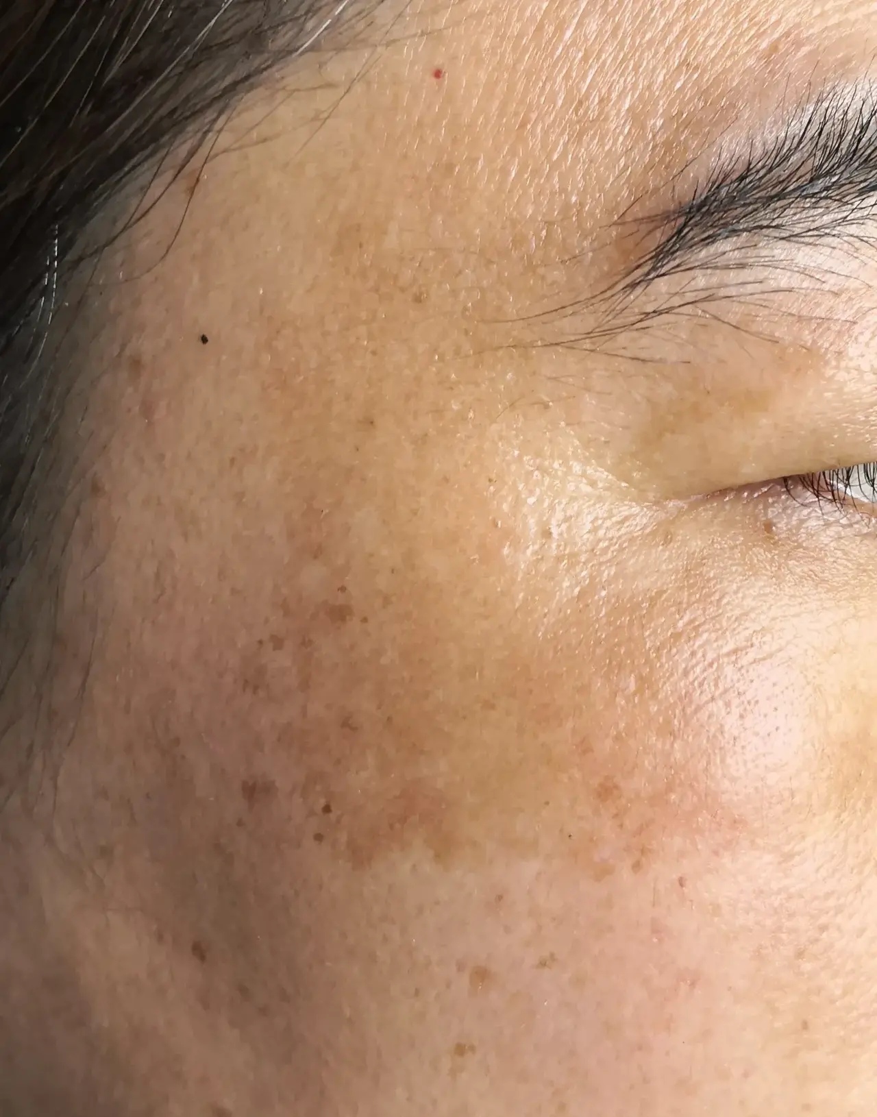 氨甲环酸为什么可以去除脸上的黑斑?