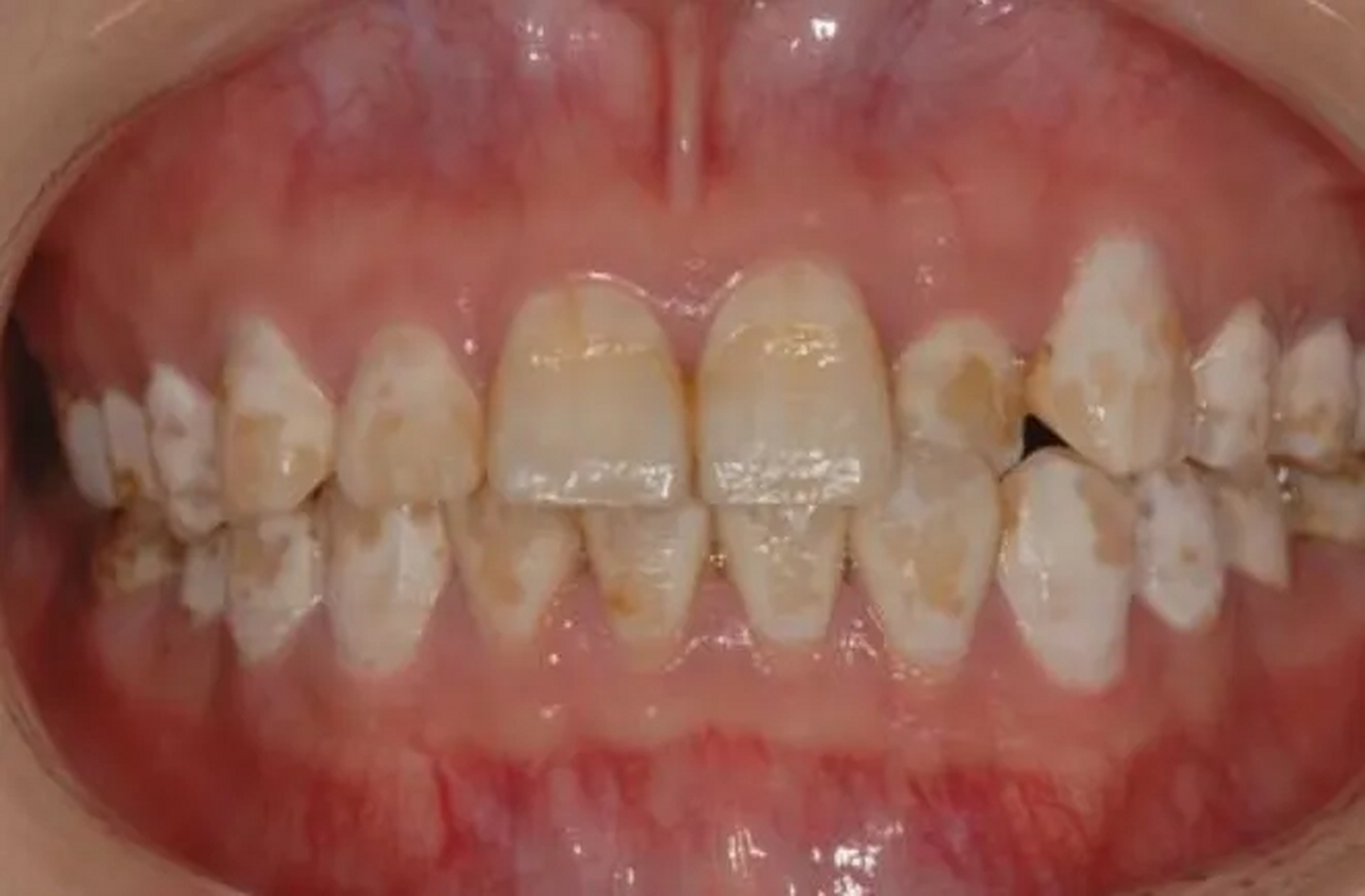 氟斑牙又称斑釉或黄斑牙,是一种与饮用水中氟含量过高有关的牙齿疾病