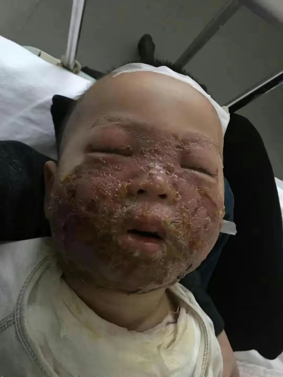 面部烫伤严重  每个家庭都有孩子,每个宝宝也都是父母心尖上的宝贝,但