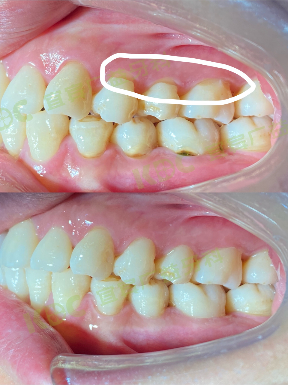 它是牙齿颈部经过缓慢消耗而形成的缺损,呈"v〞 状,由于它外形酷似