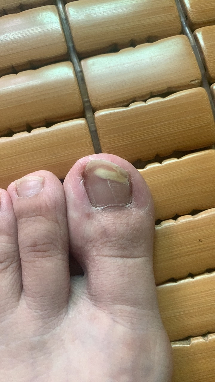 刚开始只是一点点,后来越来越大了