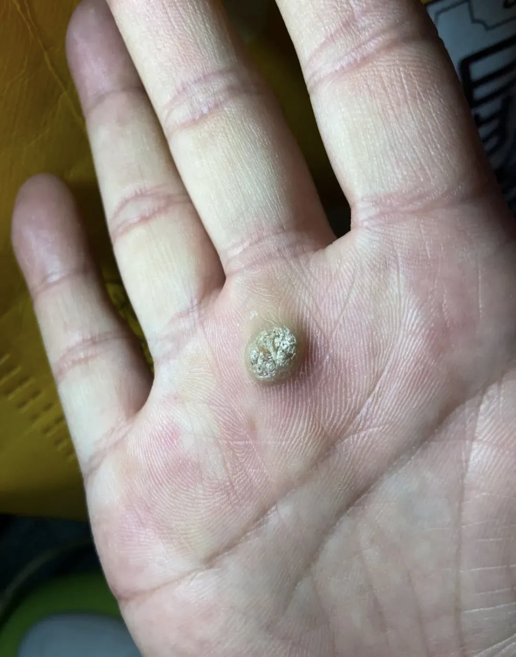 这就是传说中的鸡眼吗?可以用剪掉吗