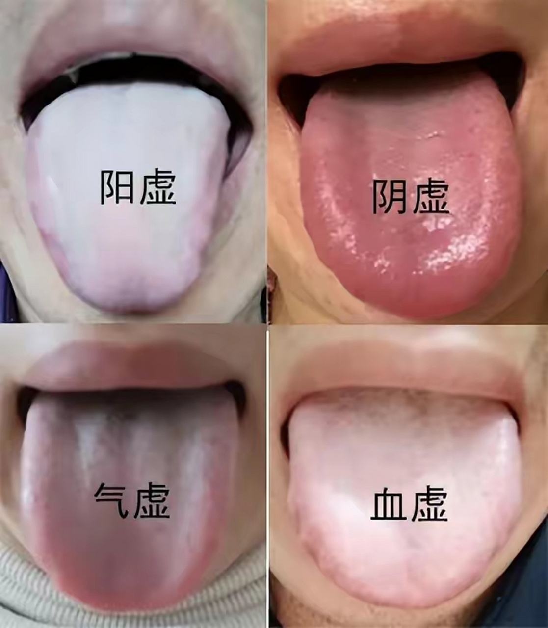 正常舌苔图片 阴虚图片