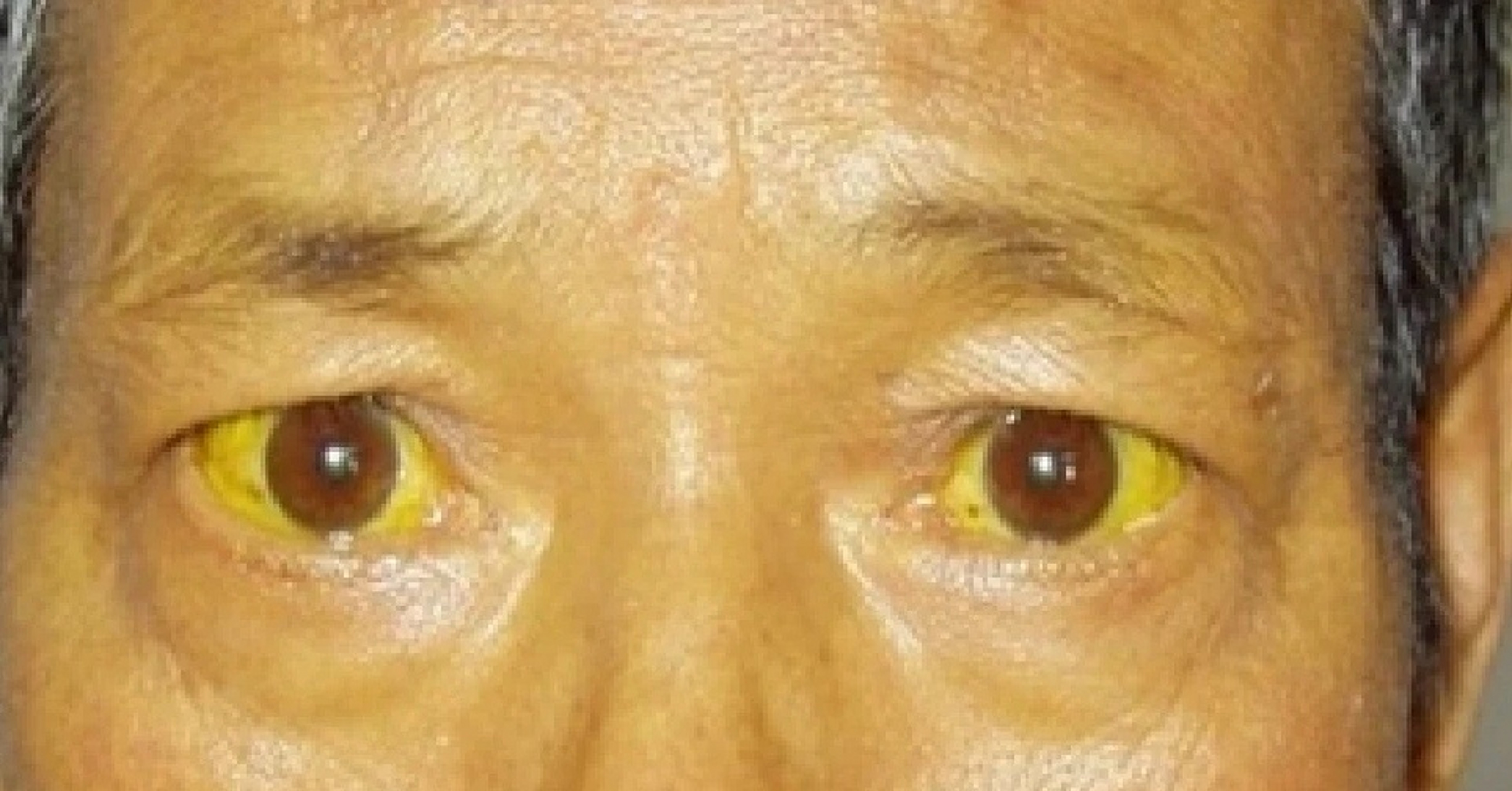 这三种是典型的肝病面容: 1,眼圈发黑 2,巩膜发黄 3,面色蜡黄 如果你