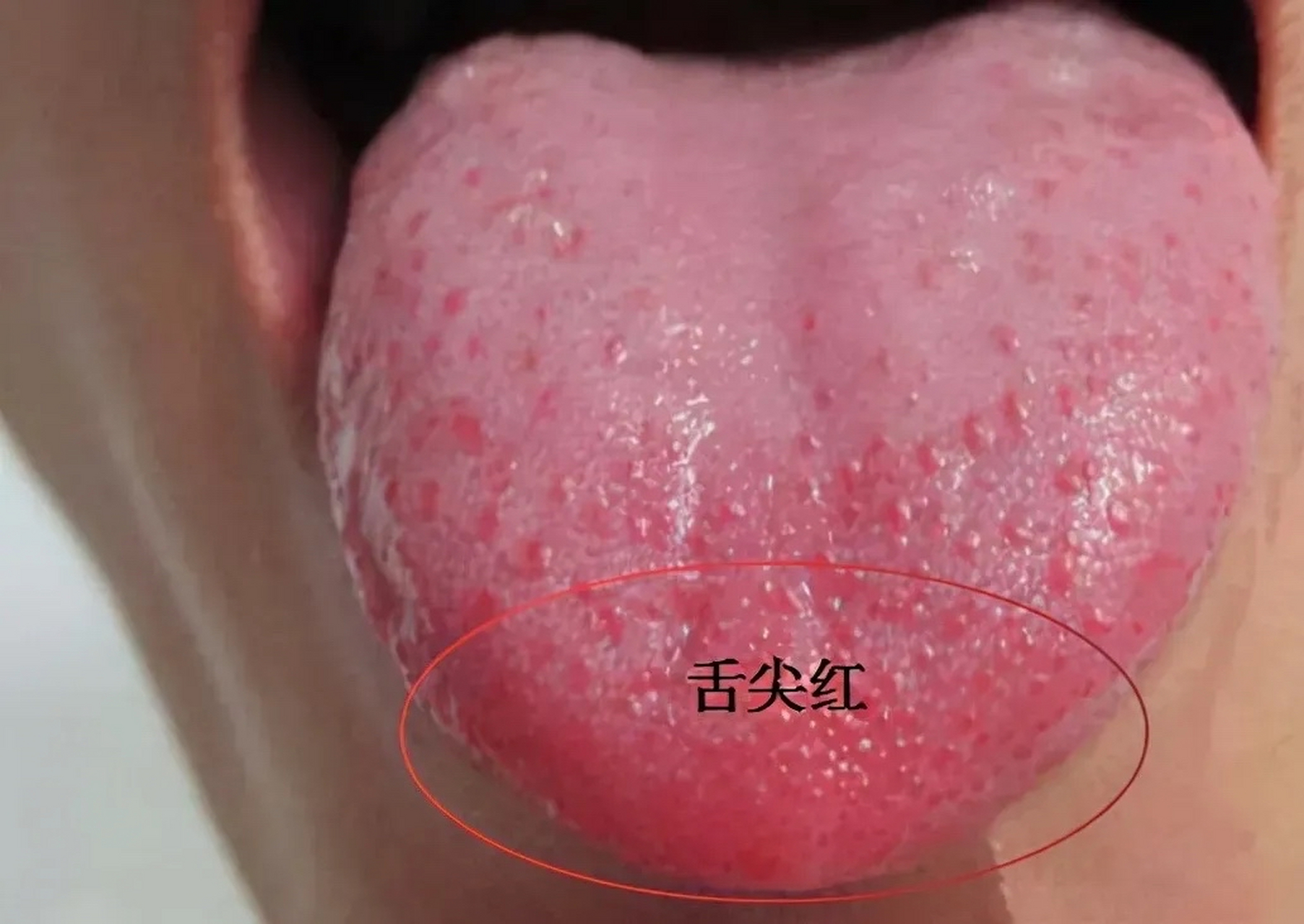 45岁的一位患者, 舌体正常,舌尖很红, 你是不是也这样?