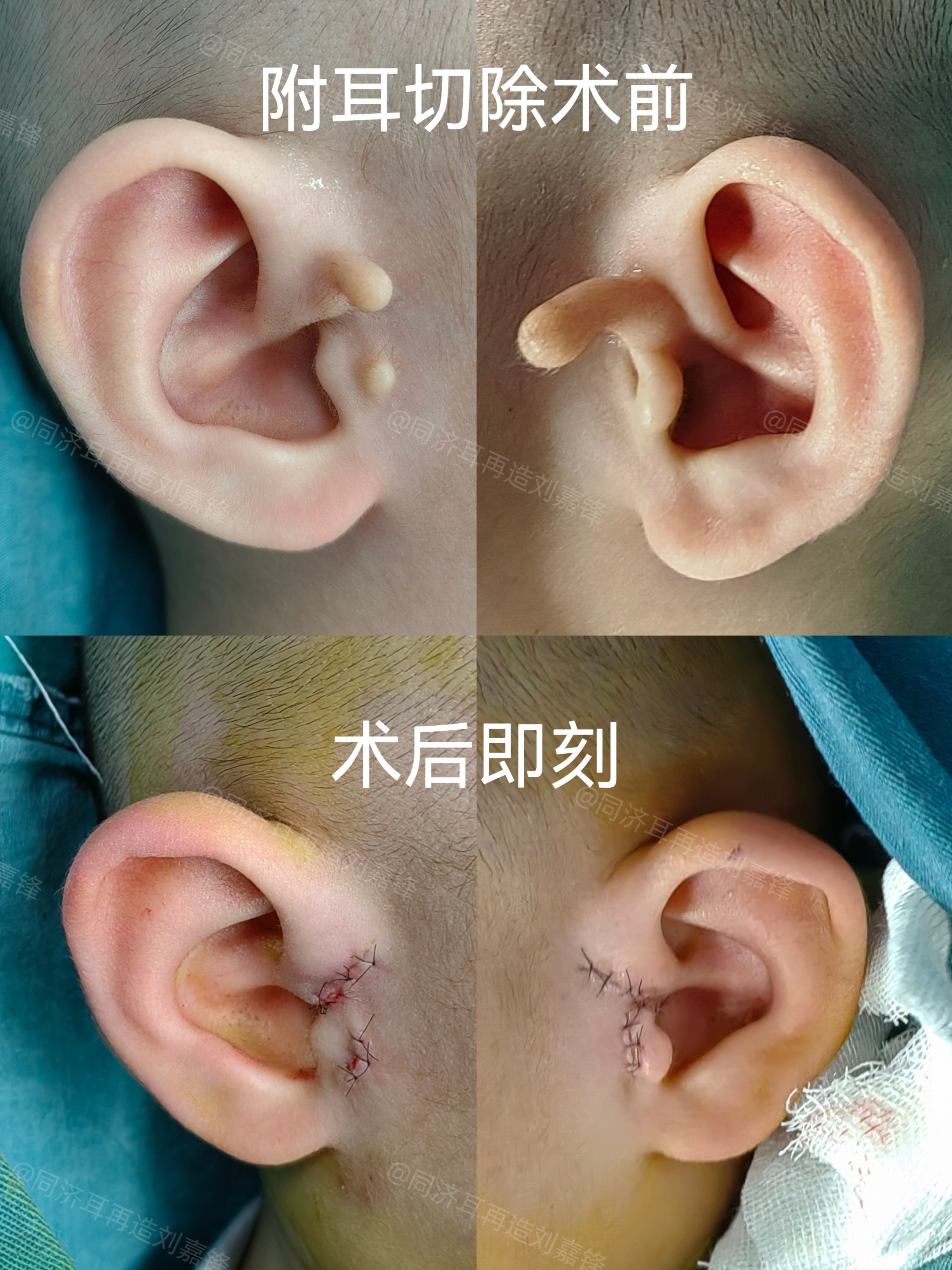 这种情况在医学上被称做附耳,也是老话常说的"栓马桩".