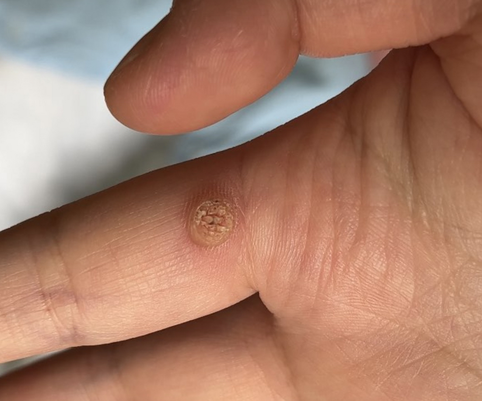 手上出现这种表面粗糙不平,刮除后中心还  有小黑点,没什么感觉的皮疹