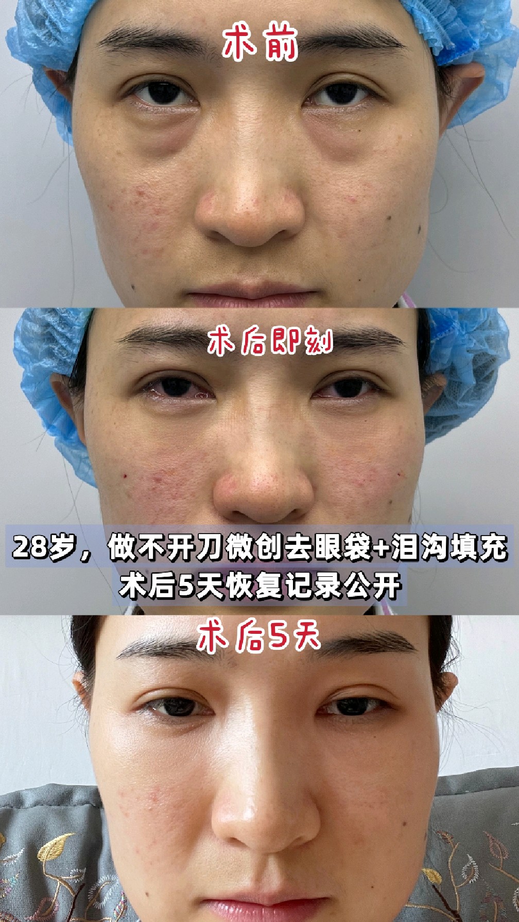 28岁,做了微创去眼袋 泪沟填充,术后5天公开手术 恢复全过程