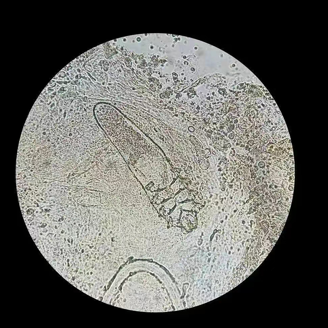 湖北男子突然失明,眼底揪出20多条虫!