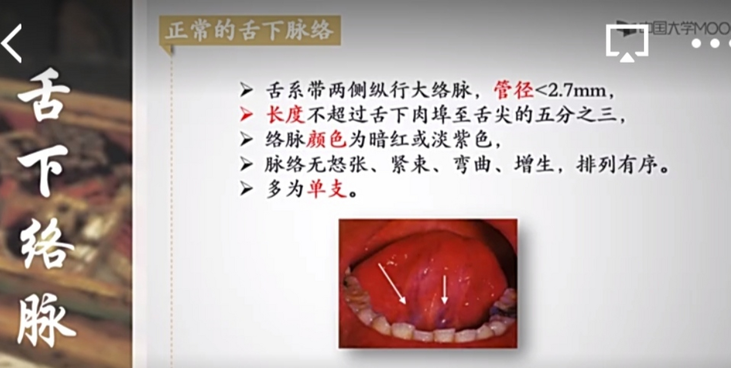 中医"望舌下络脉"一一正常表现,异常表现