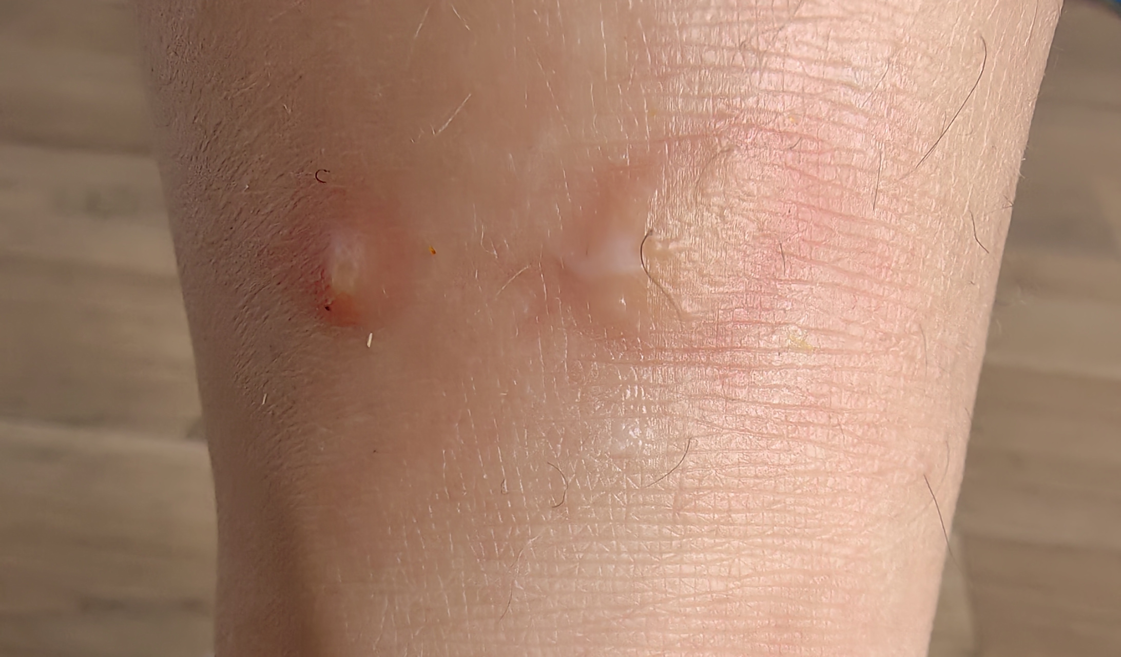 怎么会有跳蚤这么讨厌的东西[抓狂][抓狂] 据说人体质不同对跳蚤毒液