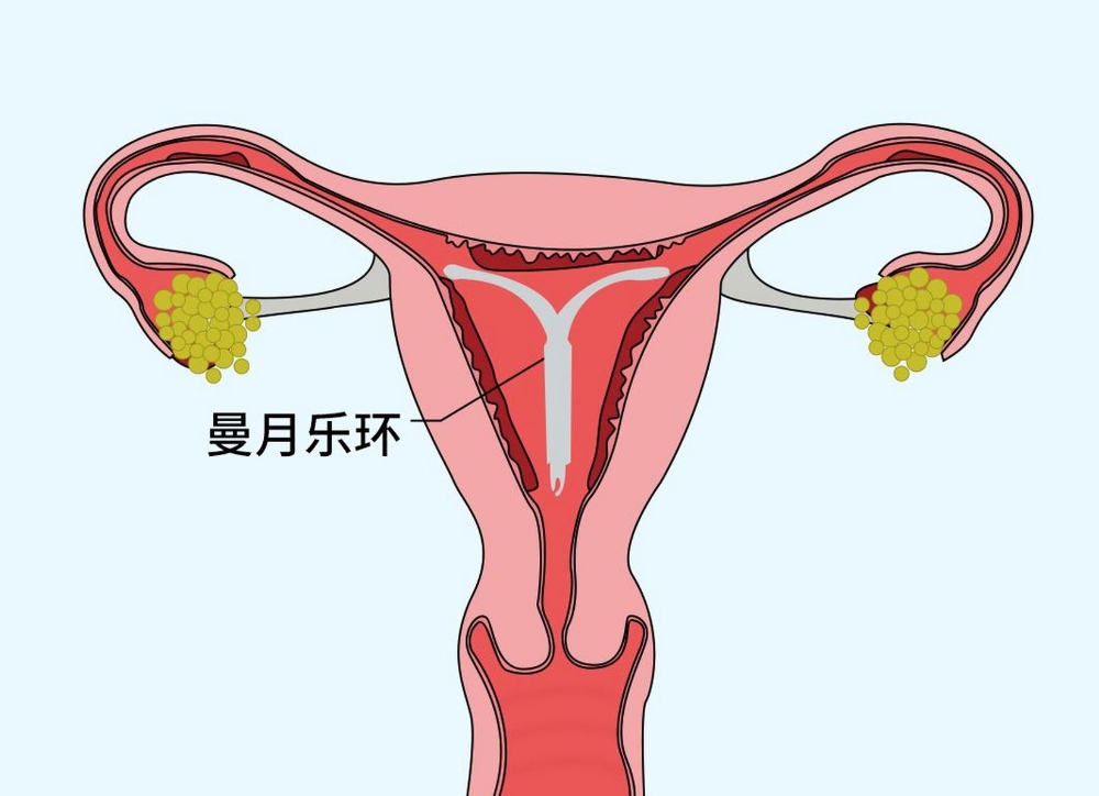 曼月乐本来是用来节育的,后面临床使用过程中发现可以使子宫内膜萎缩