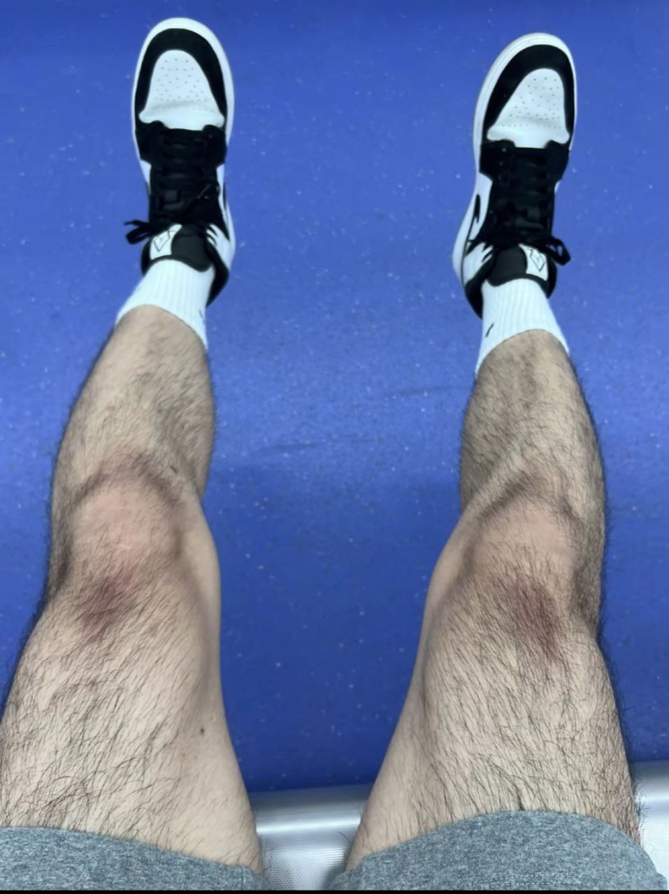 我这种体毛旺盛的男孩子总是被人调侃,说我是人猿以后找不着对象,这是
