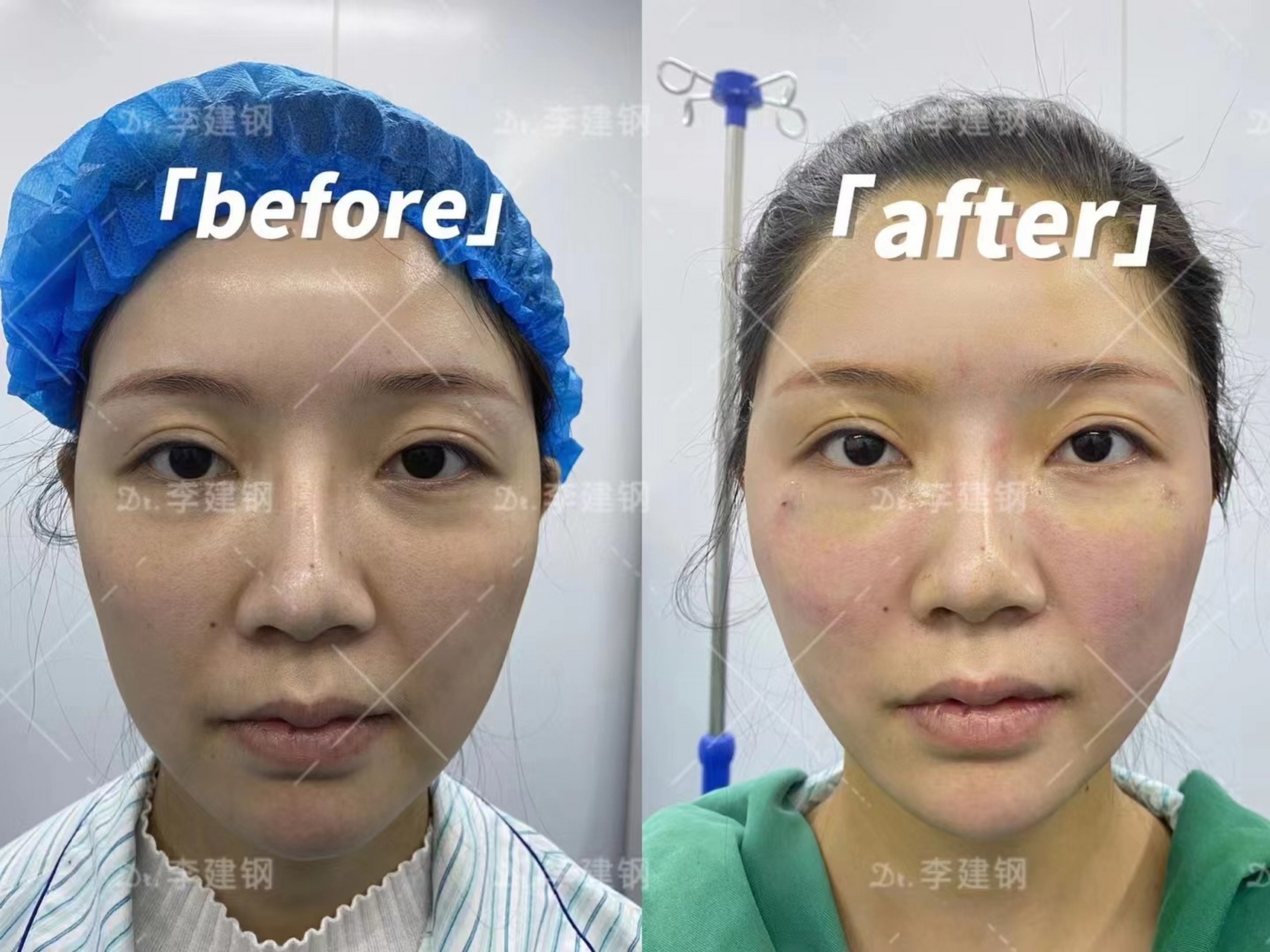 苹果肌复位案例分析 术前:苹果肌下垂导致鼻唇沟明显,主要想提升苹果