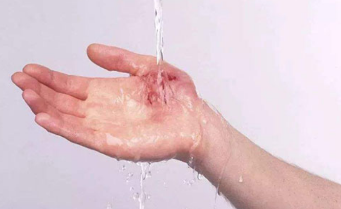 孩子烫伤后,是先脱衣服是还是先冲水?一步做错,孩子伤情更严重