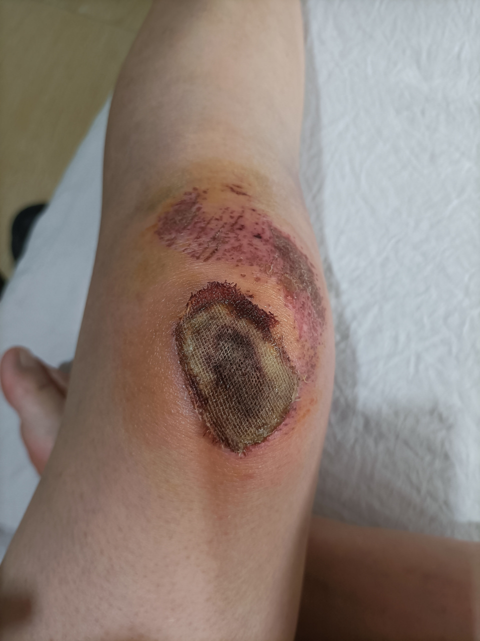 腿受伤了走不了路,让11岁的儿子扶我上厕所,人家给我床头放个棍,说他