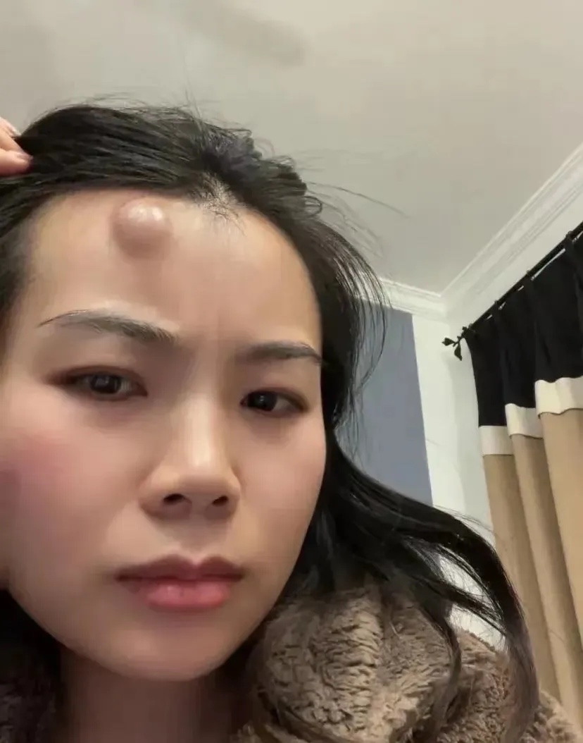 没想到刚才上厕所撞了一下,现在头上这么大一个包