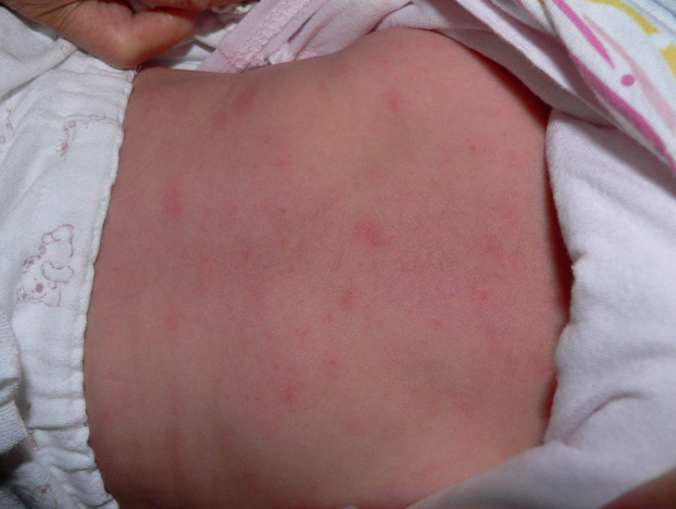 搬新家宝宝出现红斑 原来不是蚊子咬的那么简单