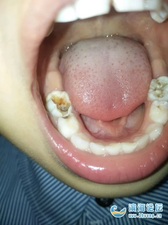 你家的孩子牙齿有这种情况吗?一定要重视起来,尽早治疗